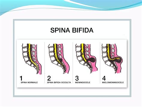 history spina bifida icd 10
